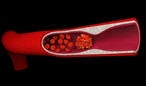 3 основни причини за появата на съсиреци