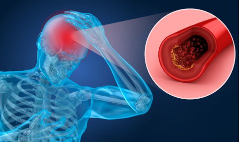 Симптомите на „тихия“ инсулт