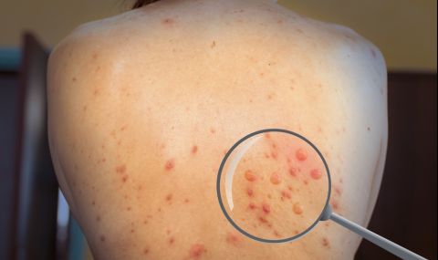 Гърция: Първият случай на маймунска шарка е официално потвърден с лабораторни тестове