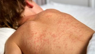 Случаите на морбили в Бяла Слатина са вече 17